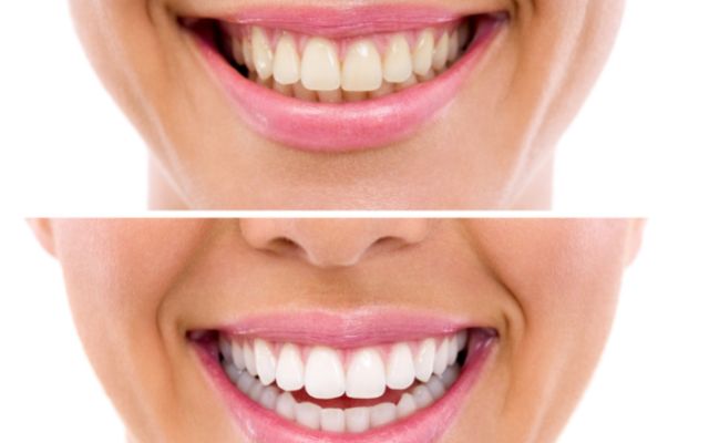 Candidates For Whitening Treatment​