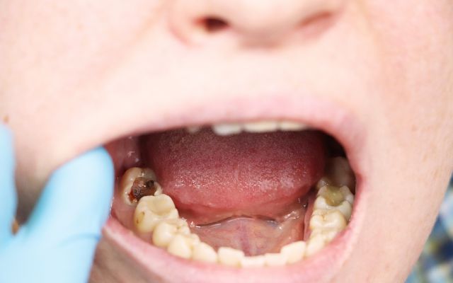 Nguyên nhân sâu răng trẻ em