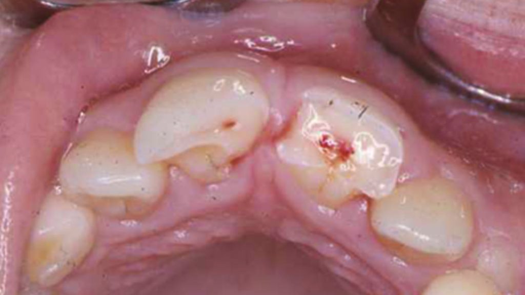 Dentin Fracture