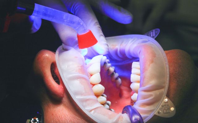 Dental Filling Procedure​