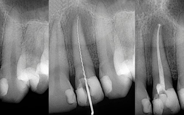 Root Canal Treatment Procedure​