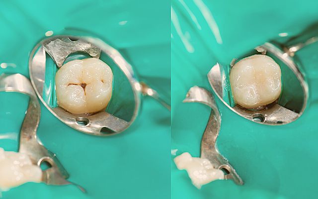 Trám răng composite