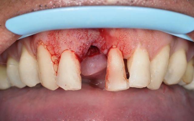 what is Avulsed Tooth