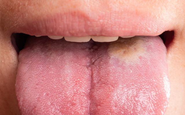 what is oral cancer