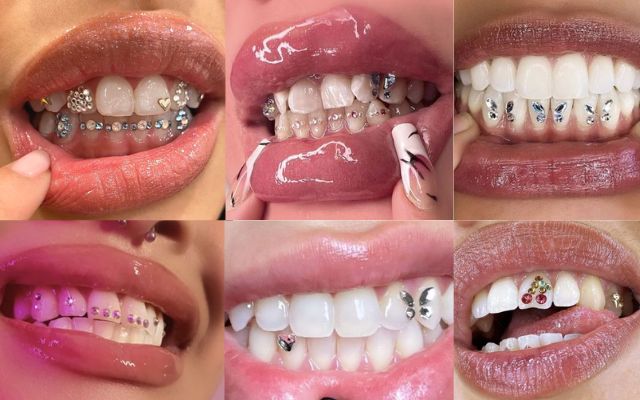 răng đính đá là gì