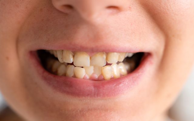 What Causes Tooth Discoloration?​