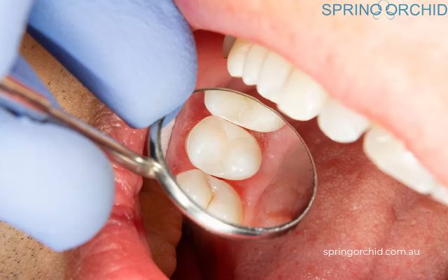 Dental Sealants' Benefits
