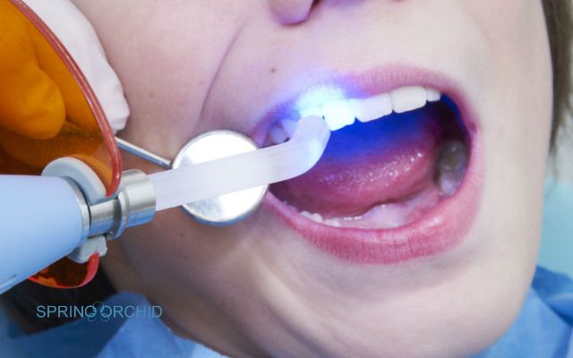 When Should You Use A Dental Sealant