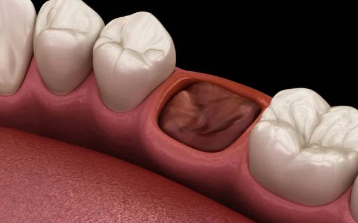 Dry Socket Tooth: Causes, Symptoms, Treatment & Prevention