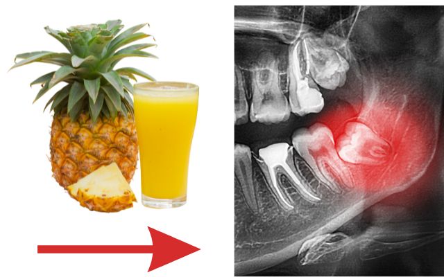 Pineapple Juice For Wisdom Tooth Pain?
