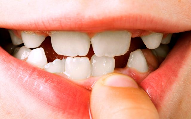 What are the symptoms of Snag Tooth?