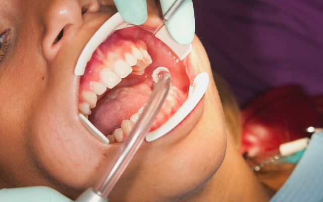 Treatments For Trench Mouth​