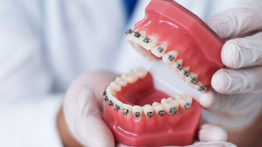 Advice On Treating Protruding Teeth