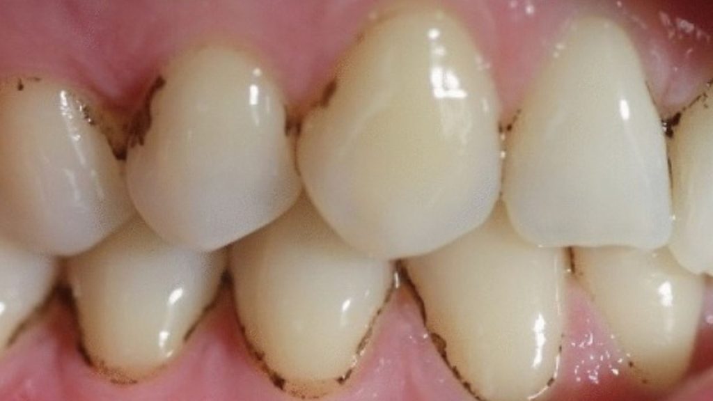What Causes Black Lines on Teeth?