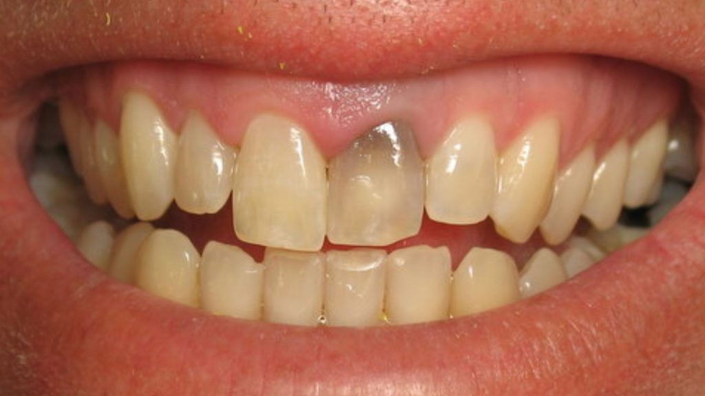 What Causes Grey Teeth?