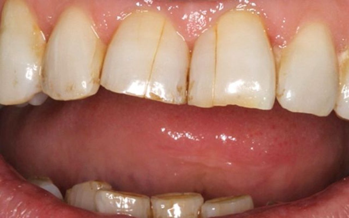 From Chips To Craze Lines: All About Cracked Teeth