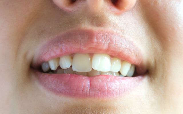 Reasons of Twisted Teeth