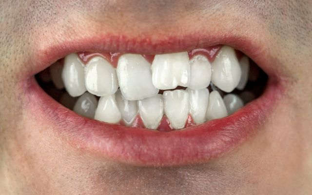 What Is Twisted Teeth?​