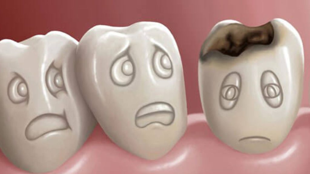 Dangers of Ignoring Dental Caries