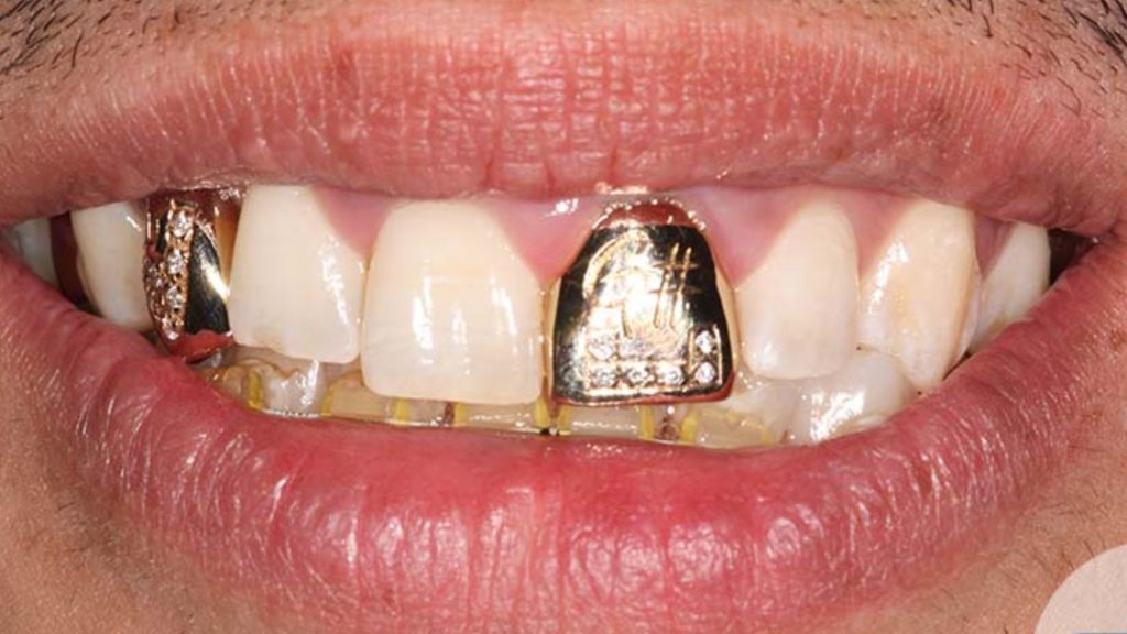 Gold Tooth Implant