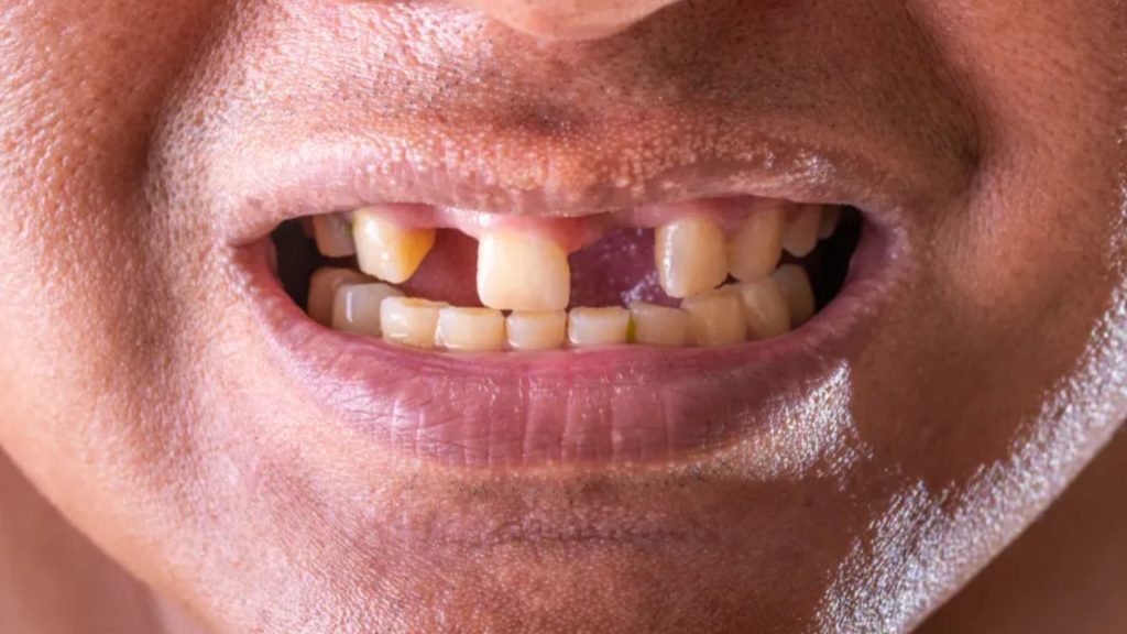 Is Tooth Reconstruction Possible?