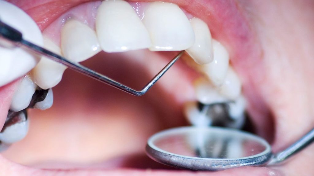 Treating Dental Decay