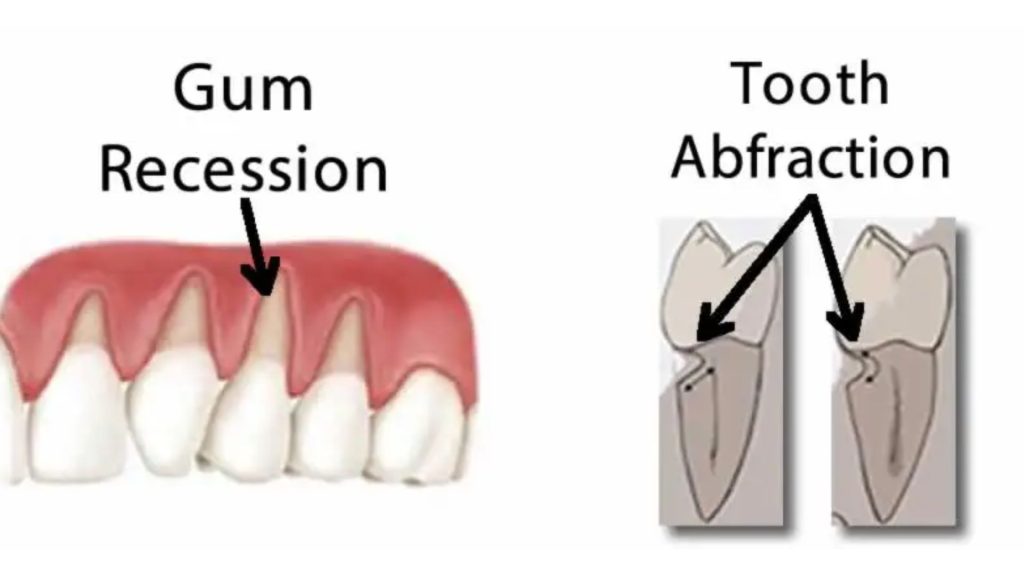 Abfraction vs Gum Recession