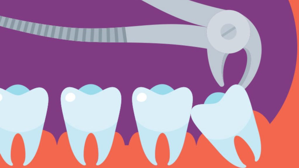 Explain Wisdom Teeth Removal Recuperation
