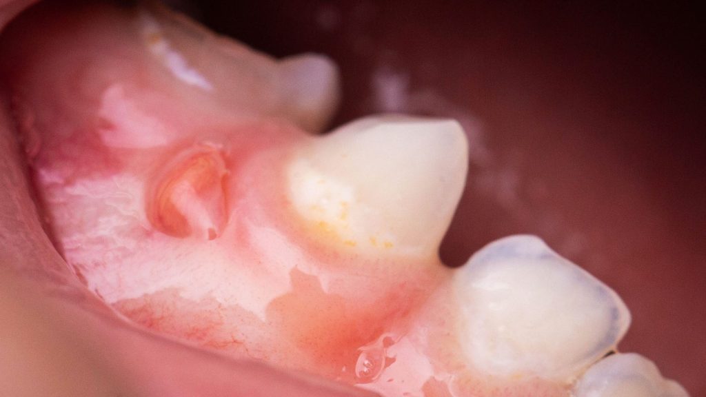 swollen gum around one tooth