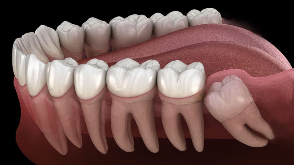 How Long Is Wisdom Teeth Recovery