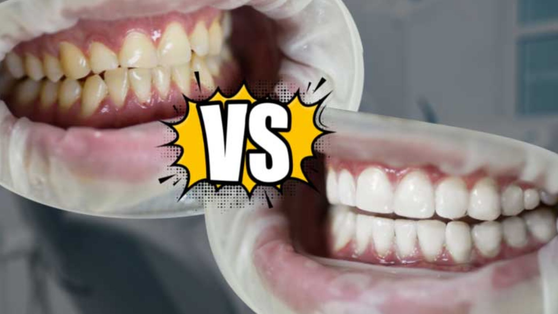 Lumineers Teeth Vs Porcelain Veneers Which Is Better 5419