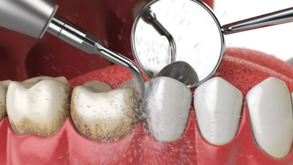 Scale And Clean vs Airflow Dental Cleaning