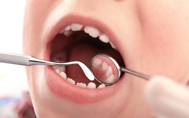 Why Your Kid Needs Dental Sealants?