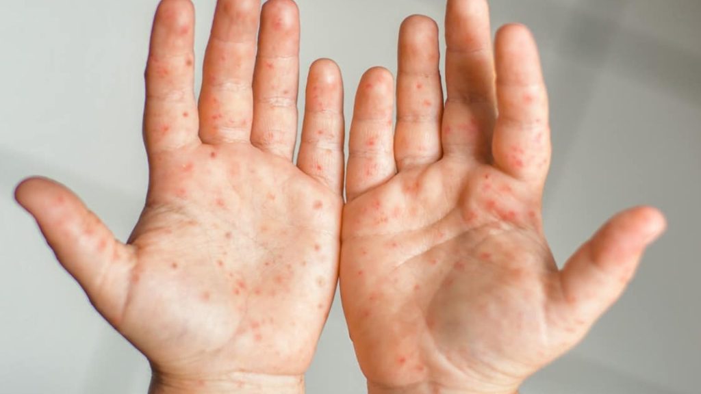 Hand, Foot, And Mouth Disease