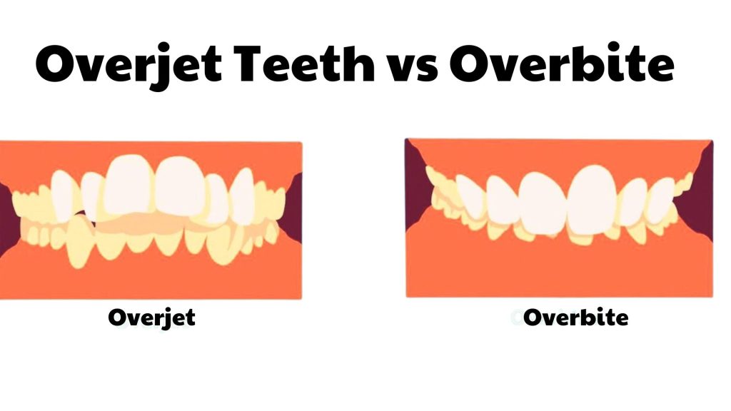 Overjet Teeth vs Overbite