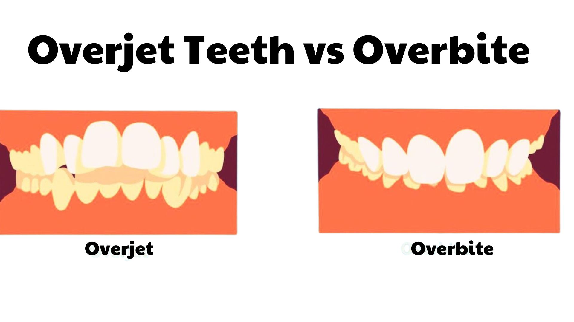 Overjet Teeth Vs Overbite What S Different Spring Orchid Dental