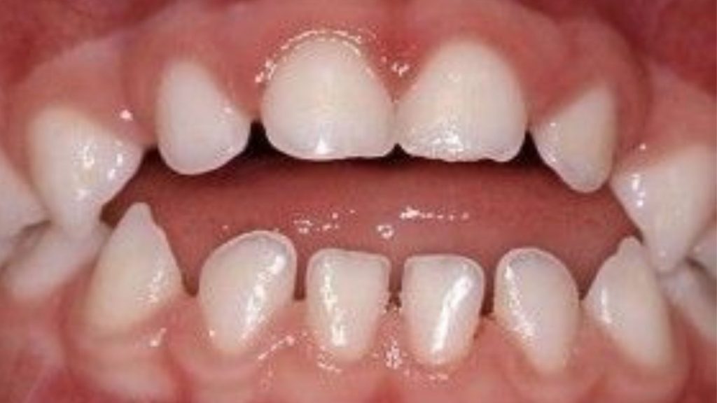 Pacifier Teeth