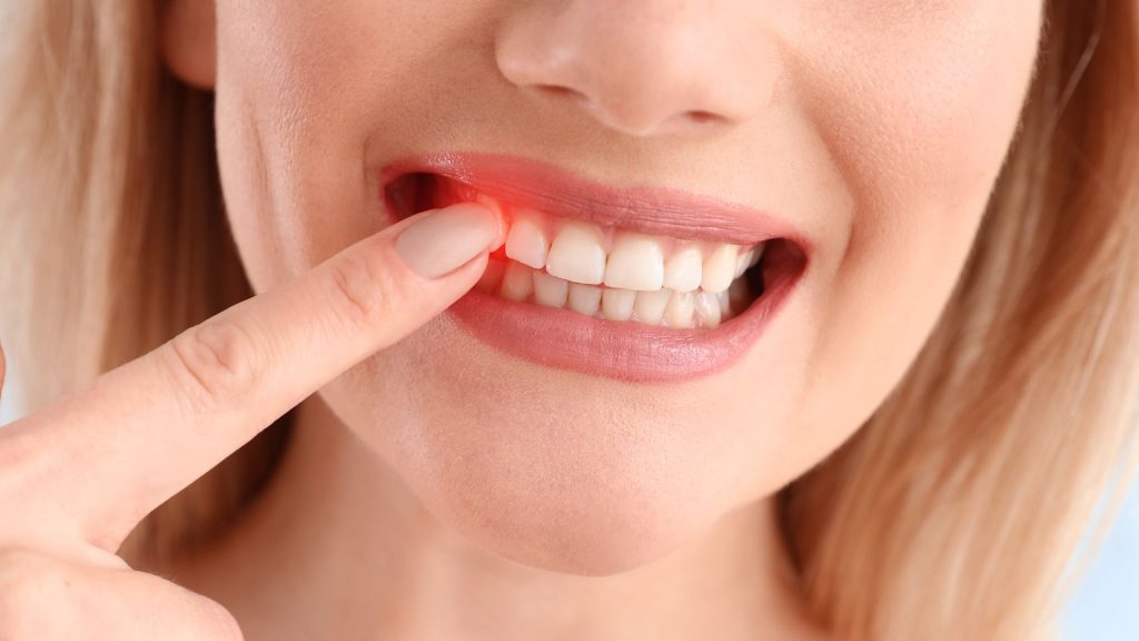 How to Stop Bleeding Gums at Home