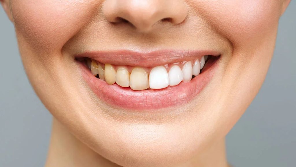 Understanding Tooth Calcium Deposits