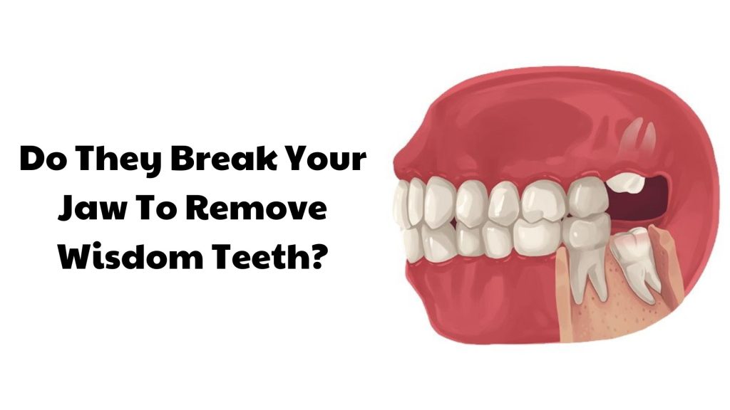 Do They Break Your Jaw To Remove Wisdom Teeth?