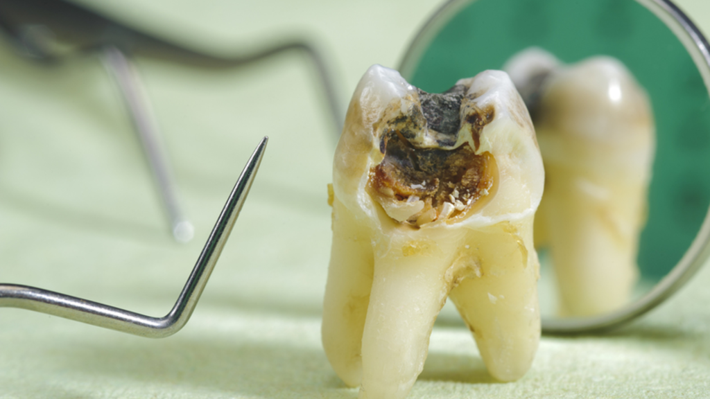 How To Avoid Black Teeth