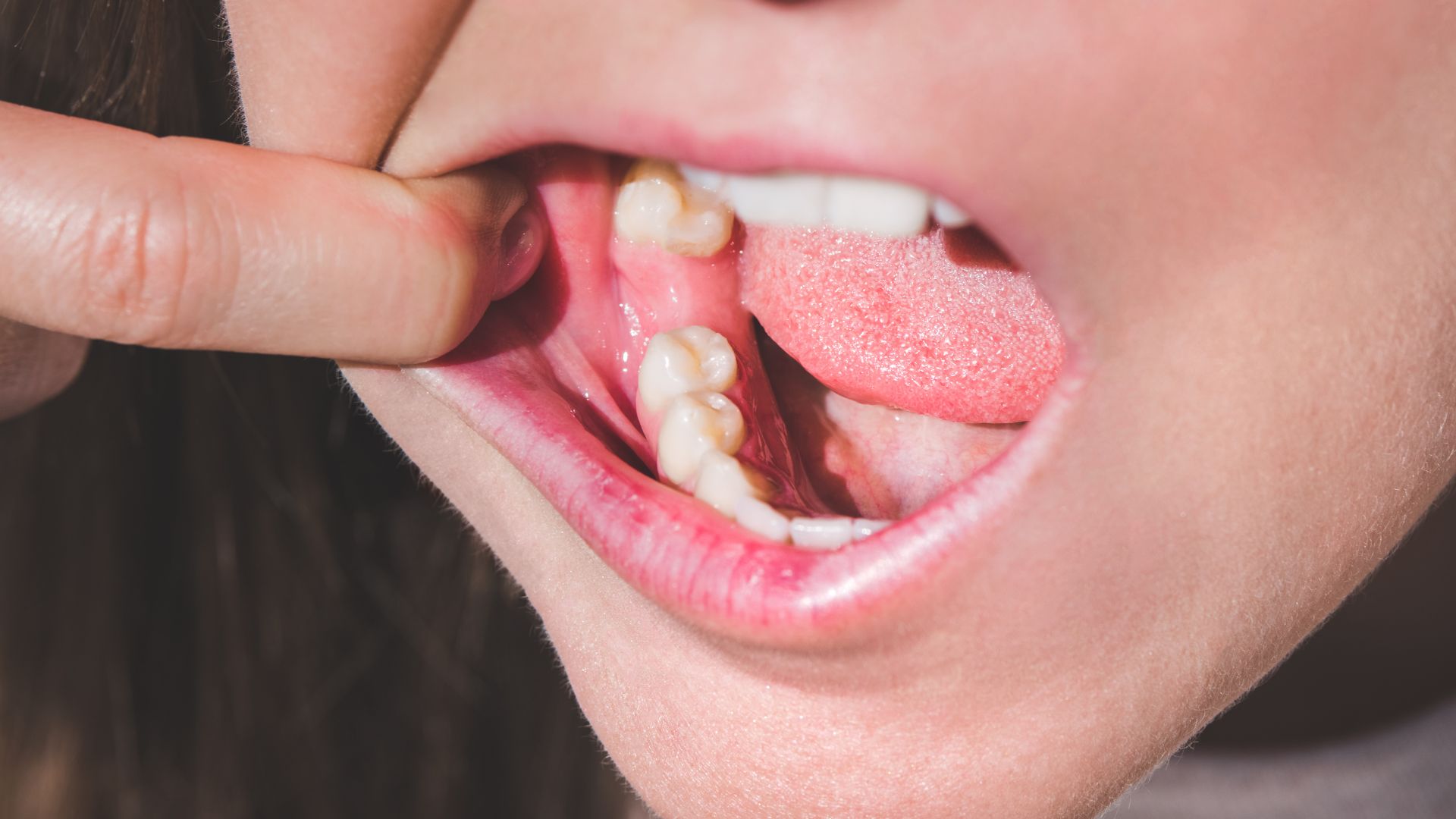 When To Stop Using Gauze After Tooth Extraction? Dentist Answer