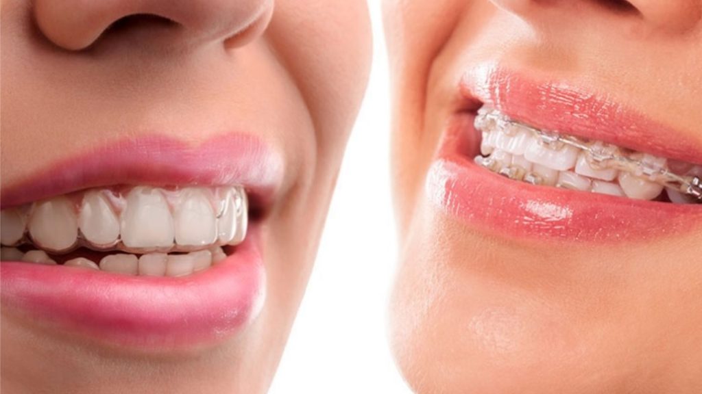 How Much Do Braces Cost In Australia