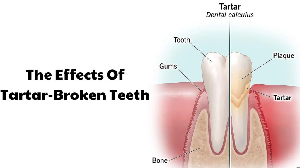 The Effects Of Tartar-Broken Teeth
