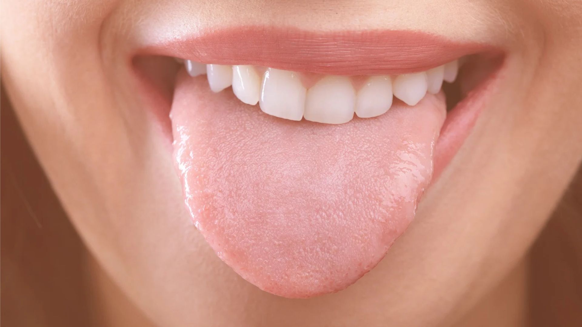 teeth-marks-on-tongue-causes-prevent-at-spring-orchid-dental