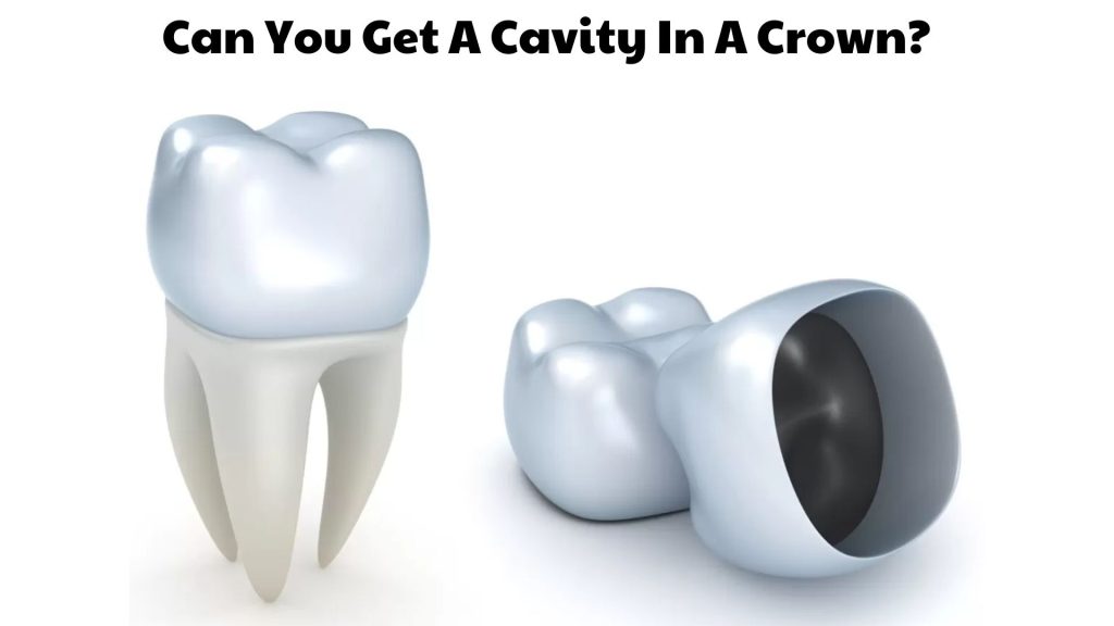 Can You Get A Cavity In A Crown