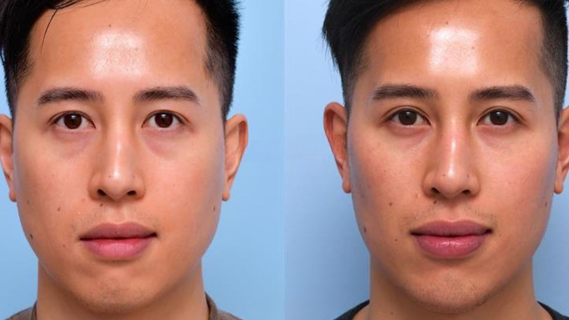 Wisdom Teeth Before And After vrogue.co