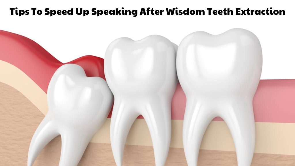 Tips To Speed Up Speaking After Wisdom Teeth Extraction