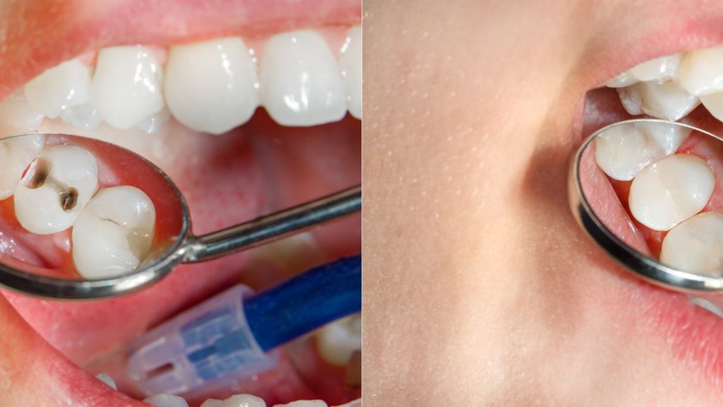 Way To Avoid Crown Tooth Decay