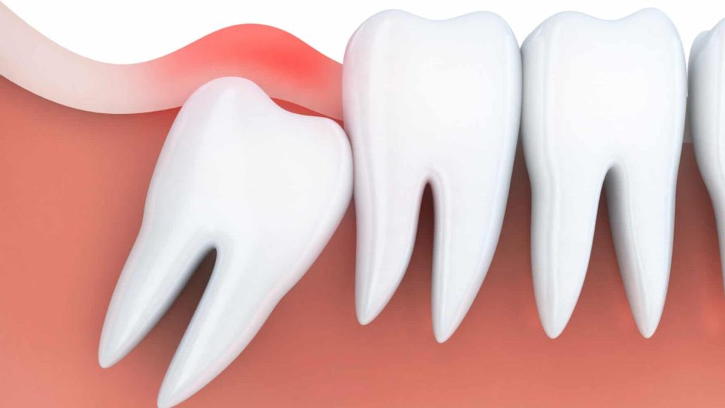 Do Dentists Break Your Jaw To Remove Wisdom Teeth
